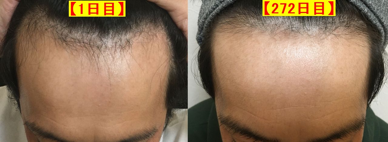 ダテオのaga治療日記 3ヶ月 6ヶ月目 M字ハゲの基準は 代のころの生え際が戻ってきた 76日目 132日目まで 男前チョイス