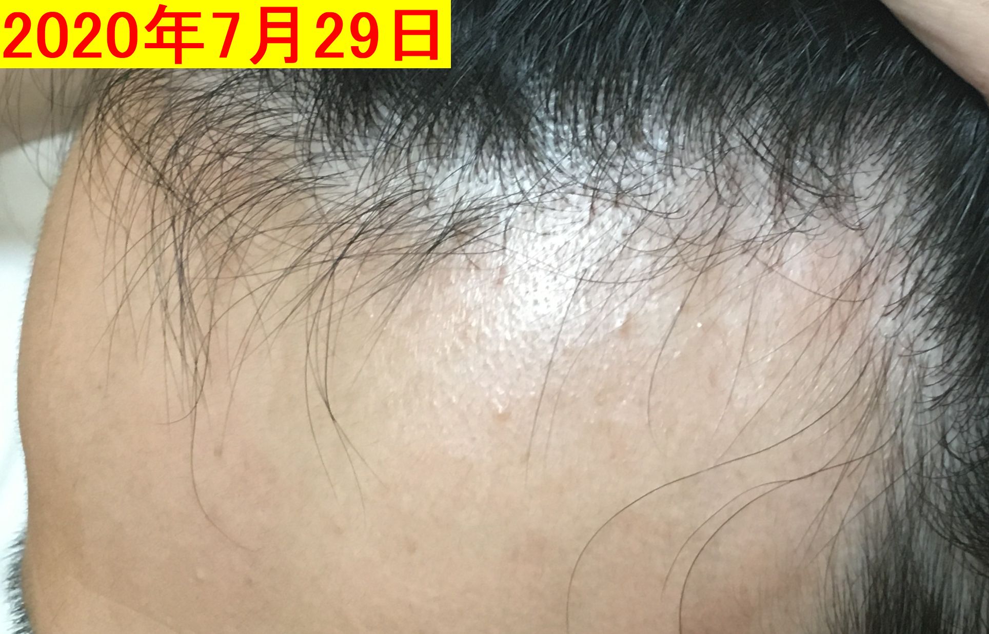 ダテオのaga治療日記 2ヶ月目 ついに産毛が生えてきた あと多毛症も 34日目 男前チョイス